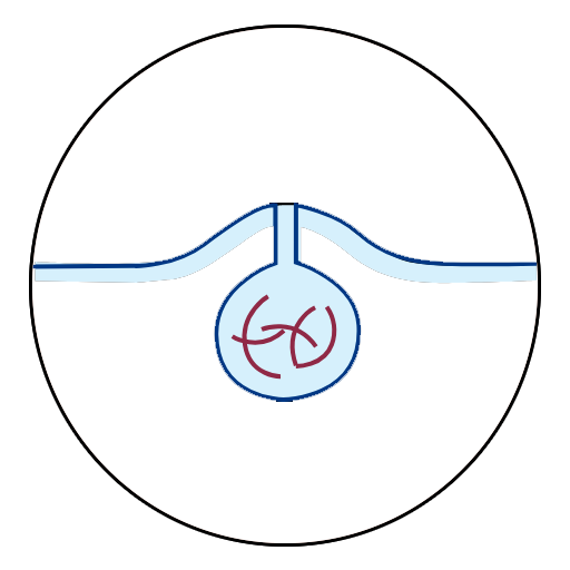 Pilonidal Sinus